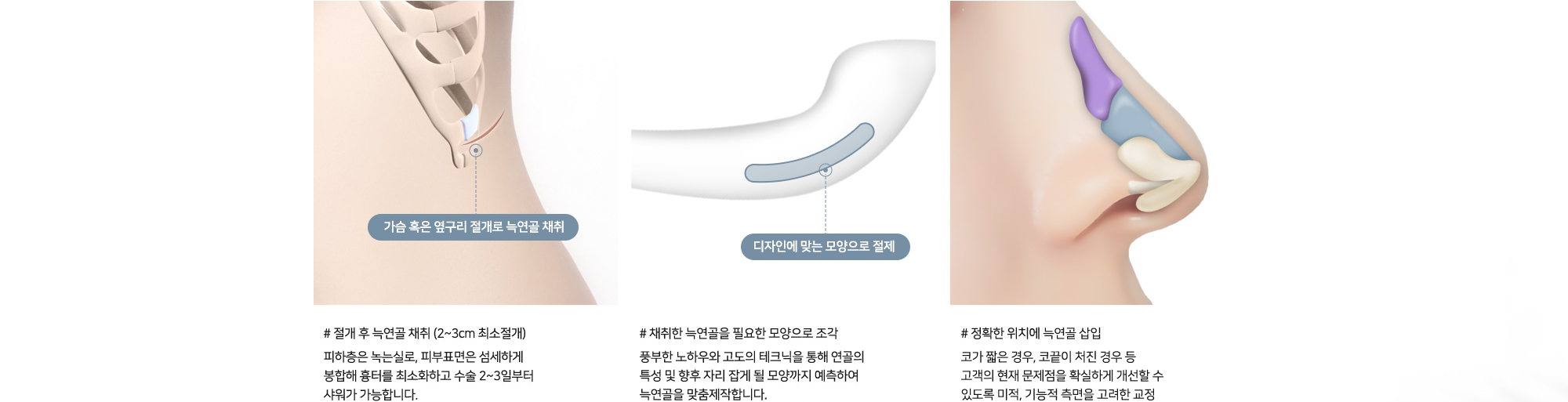 # 절개 후 늑연골 채취 (2~3cm 최소절개) : 피하층은 녹는실로, 피부표면은 섬세하게 봉합해 흉터를 최소화하고 수술 2~3일부터 샤워가 가능합니다. (가슴 혹은 옆구리 절개로 늑연골 채취) # 채취한 늑연골을 필요한 모양으로 조각 : 풍부한 노하우와 고도의 테크닉을 통해 연골의 특성 및 향후 자리 잡게 될 모양까지 예측하여 늑연골을 맞춤제작합니다. (디자인에 맞는 모양으로 절제) # 정확한 위치에 늑연골 삽입 : 코가 짧은 경우, 코끝이 처진 경우 등 고객의 현재 문제점을 확실하게 개선할 수 있도록 미적, 기능적 측면을 고려한 교정
