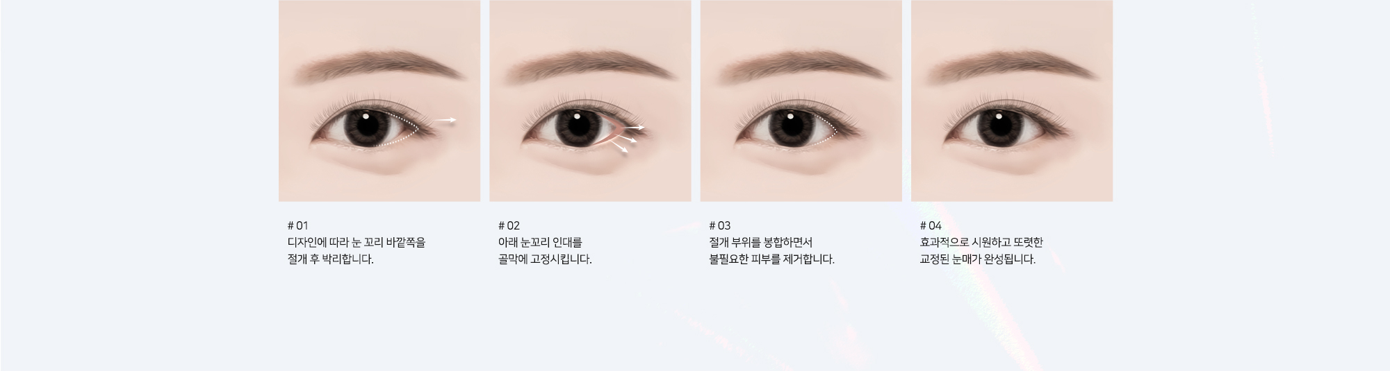 #01 디자인에 따라 눈 꼬리 바깥쪽을 절개 후 박리합니다. #02 아래 눈꼬리 인대를 골막에 고정시킵니다. #03 절개 부위를 봉합하면서 불필요한 피부를 제거합니다. #04 효과적으로 시원하고 또렷한 교정된 눈매가 완성됩니다.