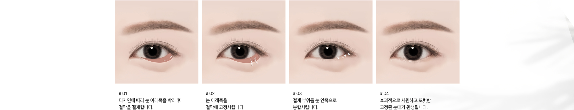 # 01 : 디자인에 따라 눈 아래쪽을 박리 후 결막을 절개합니다.   # 02 : 눈 아래쪽을 결막에 고정시킵니다.   # 03 : 절개 부위를 눈 안쪽으로 봉합시킵니다.   # 04 : 효과적으로 시원하고 또렷한 교정된 눈매가 완성됩니다.