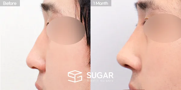 슈가성형외과 첫) 콧대 + 코끝 + 매부리코 + 절골 + 비주 지지 전후사진 - 측면 수술 전후 비교
