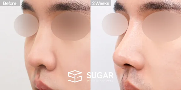슈가성형외과 재) 재수술 + 절골 + 길이 연장 + 펼침 이식 전후사진 - 45도 수술 전후 비교