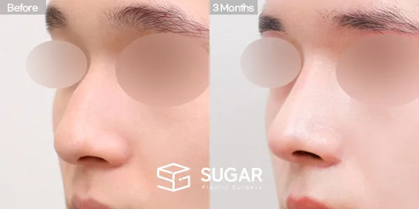 슈가성형외과 첫) 콧대 + 코끝 + 매부리코 + 긴코 + 절골 + 비중격 전후사진 - 45도 수술 전후 비교