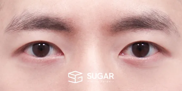 슈가성형외과 첫) 자연유착 + 눈매교정 전후사진 - 수술 후