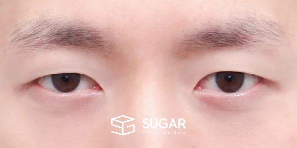 슈가성형외과 첫) 자연유착 + 눈매교정 전후사진 - 수술 전