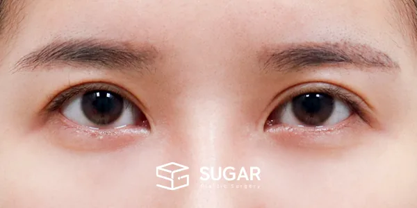 슈가성형외과 재) 재수술 + 절개(두 줄 따기) + 눈매교정 + 뒤밑트임 전후사진 - 수술 전