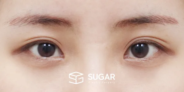 슈가성형외과 첫) 절개 + 눈매교정 + 윗트임 + 뒤밑트임 전후사진 - 수술 전