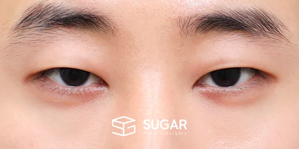 슈가성형외과 첫) 자연유착 + 눈매교정 + 뒤밑트임 전후사진 - 수술 전