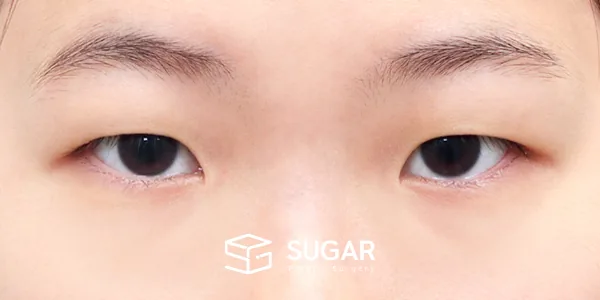 슈가성형외과 첫) 절개 + 눈매교정 + 앞트임 전후사진 - 수술 전