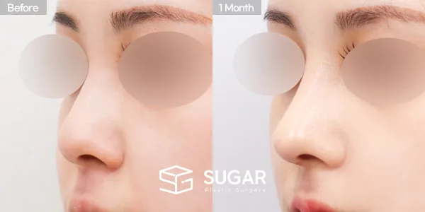 슈가성형외과 첫) 콧대 + 코긑 + 복코 + 절골 전후사진 - 45도 수술 전후 비교
