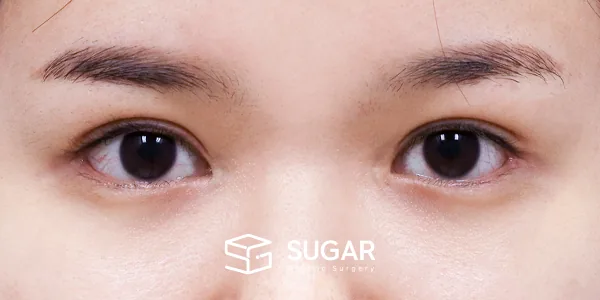 슈가성형외과 첫) 절개[R] + 뒤밑트임 전후사진 - 수술 후