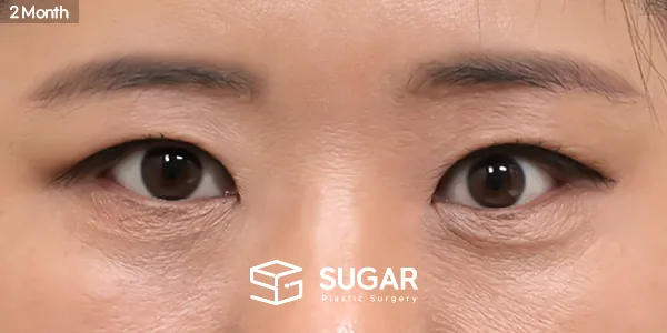 슈가성형외과 첫) 눈썹 거상 + 자연유착 + 윗트임 전후사진 - 수술 후