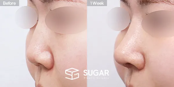 슈가성형외과 첫) 무보형물 + 자가늑 + 귀연골 + 복코 + 비주연장 + 비순각교정 + 절골 + 매부리 + 귀 뒤 근막 전후사진 - 45도 수술 전후 비교