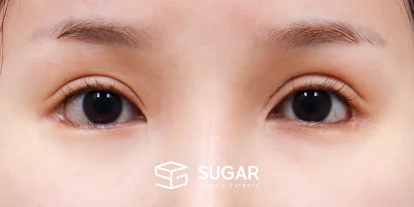 슈가성형외과 재) 재수술 + 절개(두 줄 따기) + 눈매교정 + 뒤트임 + 눈 위 지방이식 + 안검내반 전후사진 - 수술 전