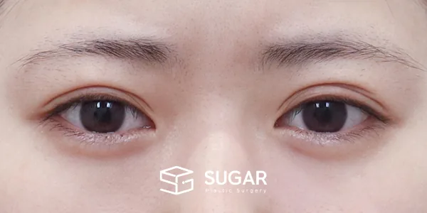 슈가성형외과 재) 재수술 + 절개 + 눈매교정 + 뒤밑트임 전후사진 - 수술 전