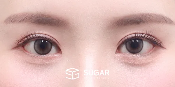 슈가성형외과 재) 재수술 + 절개(두 줄 따기) + 눈매교정 + 뒤밑트임 전후사진 - 수술 후