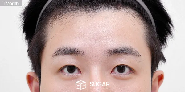 슈가성형외과 첫) 이마거상 + 뒤트임 전후사진 - 수술 후