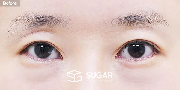 슈가성형외과 재) 재수술 + 절개 + 윗트임 + 뒤밑트임 + 눈밑지방재배치 전후사진 - 수술 전