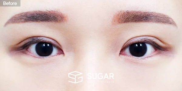슈가성형외과 재) 재수술 + 절개 + 뒤밑트임 전후사진 - 수술 전