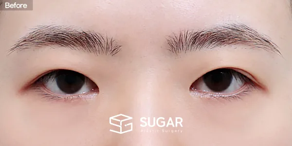 슈가성형외과 재) 재수술 + 절개 + 눈매교정 + 앞트임 전후사진 - 수술 전