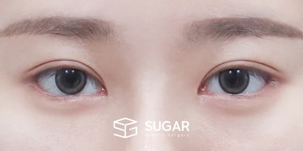 슈가성형외과 첫) 절개 + 앞트임 + 윗트임 + 뒤밑트임 전후사진 - 수술 후