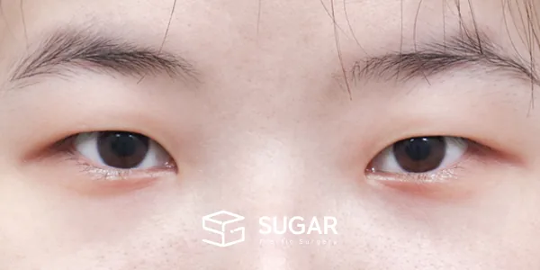슈가성형외과 첫) 절개 + 눈매교정 + 앞트임 + 뒤밑트임 전후사진 - 수술 전