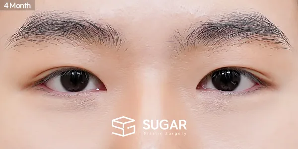 슈가성형외과 첫) 자연유착 + 눈매교정 + 앞트임 + 뒤밑트임 전후사진 - 수술 후