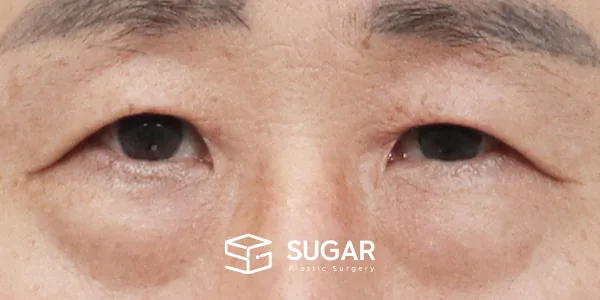 슈가성형외과 첫) 눈썹 거상 + 중안면부 거상 + 하안검 + 자연유착 + 뒤밑트임 + 눈 밑 지방 제거 전후사진 - 수술 전
