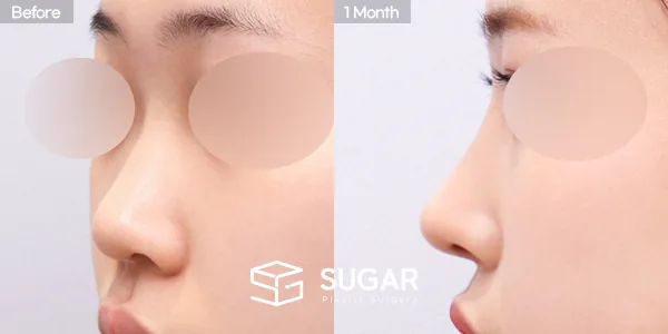 슈가성형외과 첫) 콧대 + 코끝 + 매부리코 + 복코 + 절골 + 비중격 + 귀연골 전후사진 - 측면 수술 전후 비교