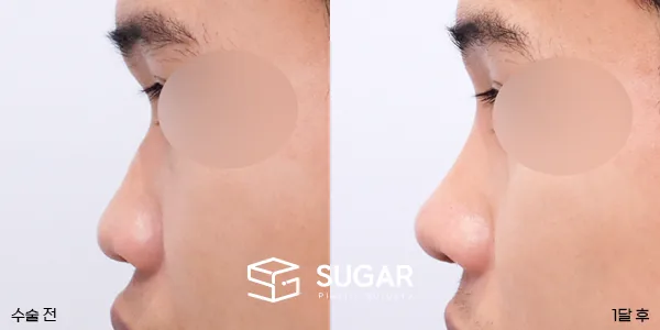 슈가성형외과 첫) 콧대 + 코끝 + 복코 + 비순각 교정 + 자가늑 전후사진 - 측면 수술 전후 비교