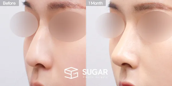 슈가성형외과 첫) 콧대 + 코끝 + 매부리코 + 귀연골 전후사진 - 45도 수술 전후 비교