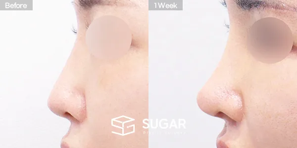 슈가성형외과 재) 재수술 + 콧대 + 코끝 + 기증늑 + 귀연골 + 귀 뒤 근막 전후사진 - 측면 수술 전후 비교
