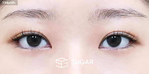 슈가성형외과 첫) 뒤밑트임 전후사진 - 수술 후