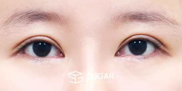 슈가성형외과 재) 밑트임 재수술 전후사진 - 수술 전