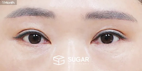 슈가성형외과 첫) 눈썹하거상술 + 자연유착 전후사진 - 수술 후