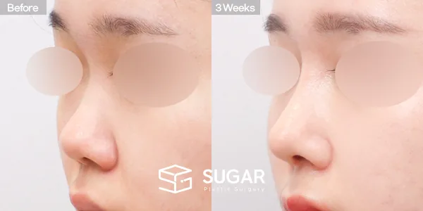 슈가성형외과 첫) 콧대 + 코끝 + 복코 + 코 선반 교정 + 귀연골 전후사진 - 45도 수술 전후 비교