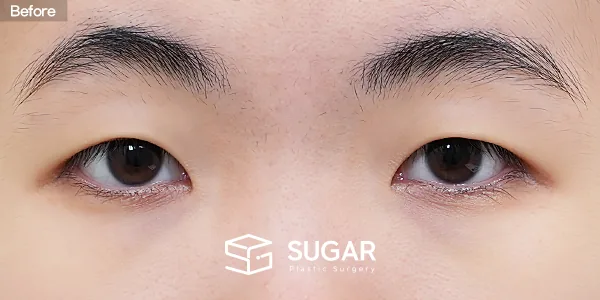 슈가성형외과 첫) 자연유착 + 눈매교정 + 윗트임 + 앞트임 전후사진 - 수술 전