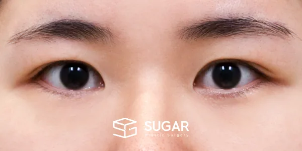 슈가성형외과 재) 재수술 + 절개 전후사진 - 수술 전