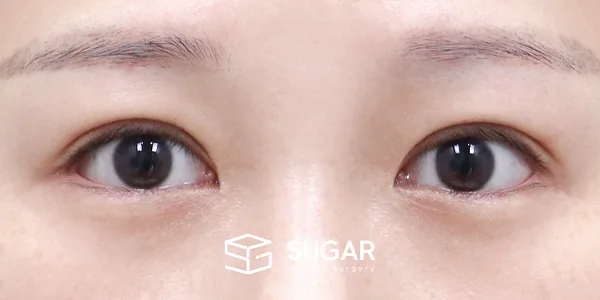 슈가성형외과 재) 재수술(두 줄 따기) + 절개 + 뒤밑트임 전후사진 - 수술 후