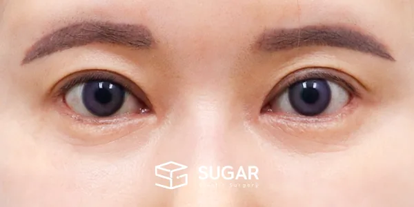 슈가성형외과 재) 재수술 + 중안부면부 거상 + 하안검 + 절개 + 눈매교정 전후사진 - 수술 후
