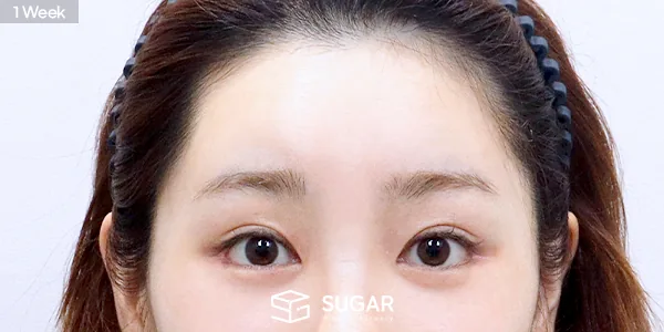 슈가성형외과 첫) 이마거상 전후사진 - 전후 비교 사진