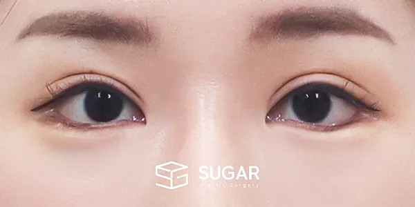슈가성형외과 첫) 눈매교정 + 윗트임 + 2Point 웨이브 밑트임 전후사진 - 수술 후
