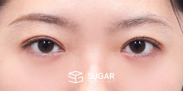 슈가성형외과 첫) 자연유착 + 눈매교정 + 윗트임 전후사진 - 수술 후