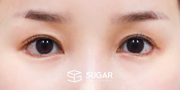 슈가성형외과 재) 재수술 + 절개(두 줄 따기) + 눈매교정 + 뒤트임 + 눈 위 지방이식 + 안검내반 전후사진 - 수술 후