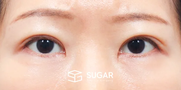 슈가성형외과 첫) 자연유착 + 눈매교정 + 윗트임 전후사진 - 수술 후