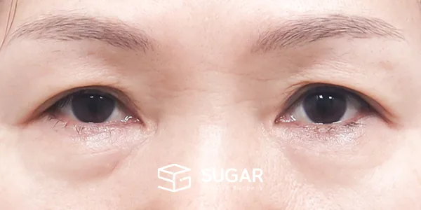 슈가성형외과 첫) 눈썹 거상 + 중안면부 거상 + 절개 + 하안검 전후사진 - 수술 전