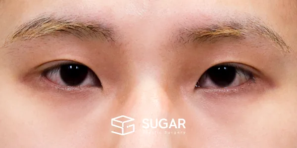 슈가성형외과 첫) 윗트임 + 뒤밑트임 전후사진 - 수술 전