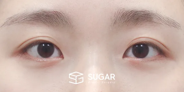 슈가성형외과 첫) 자연유착 + 눈매교정 전후사진 - 수술 전