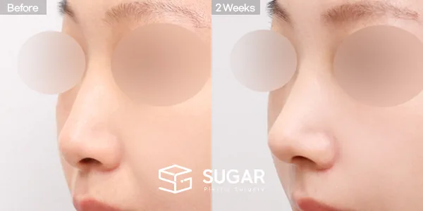 슈가성형외과 첫) 콧대 + 코끝 + 매부리코 + 무보형물 코성형 + 복코 + 절골 전후사진 - 45도 수술 전후 비교