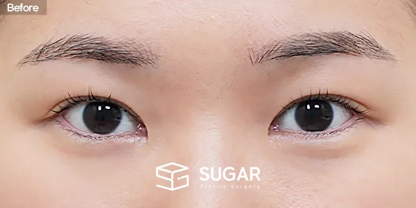 슈가성형외과 첫) 뒤밑트임 전후사진 - 수술 전