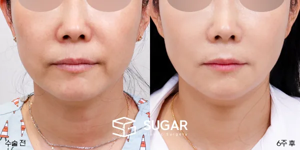 슈가성형외과 첫) 실리프팅 + 팔자주름 필러 전후사진 - 전후 비교 사진